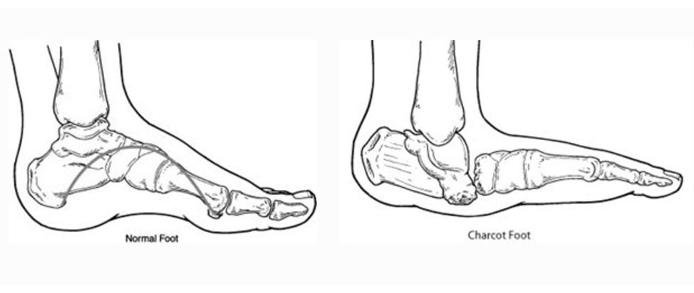 Persendian Charcot (Penyakit Sendi Neuropatik)