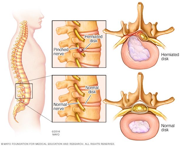 Hernia Nukleus Pulposus (Saraf Kejepit)