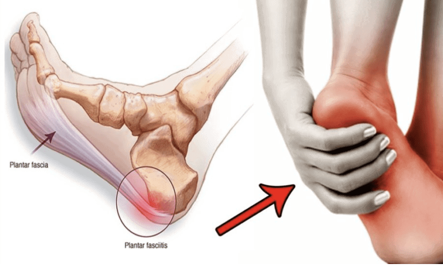 Plantar fasciitis