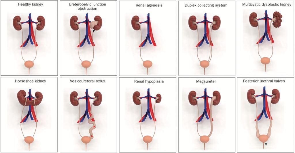 Kelainan Ginjal dan Saluran Kemih Bawaan
