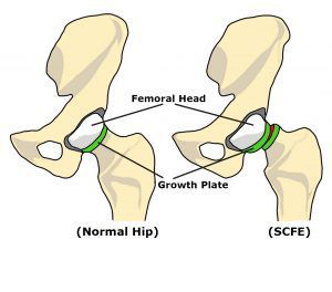 Slipped Capital Femoral Epiphysis (SCFE)