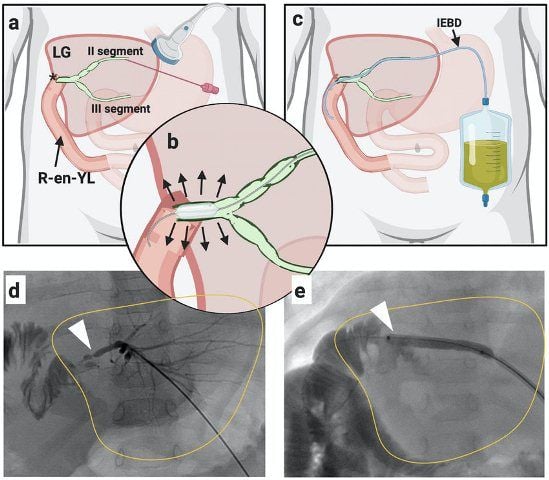 Percutaneous Transhepatic Cholangiography (Pemeriksaan Saluran Empedu)