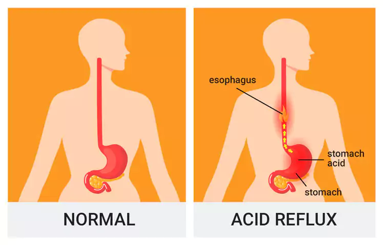 Gastroesophageal Reflux (GERD)