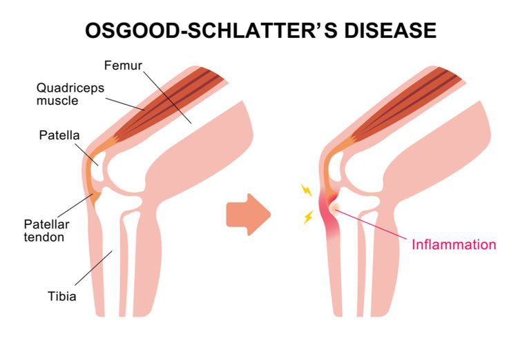 Penyakit Osgood-Schlatter