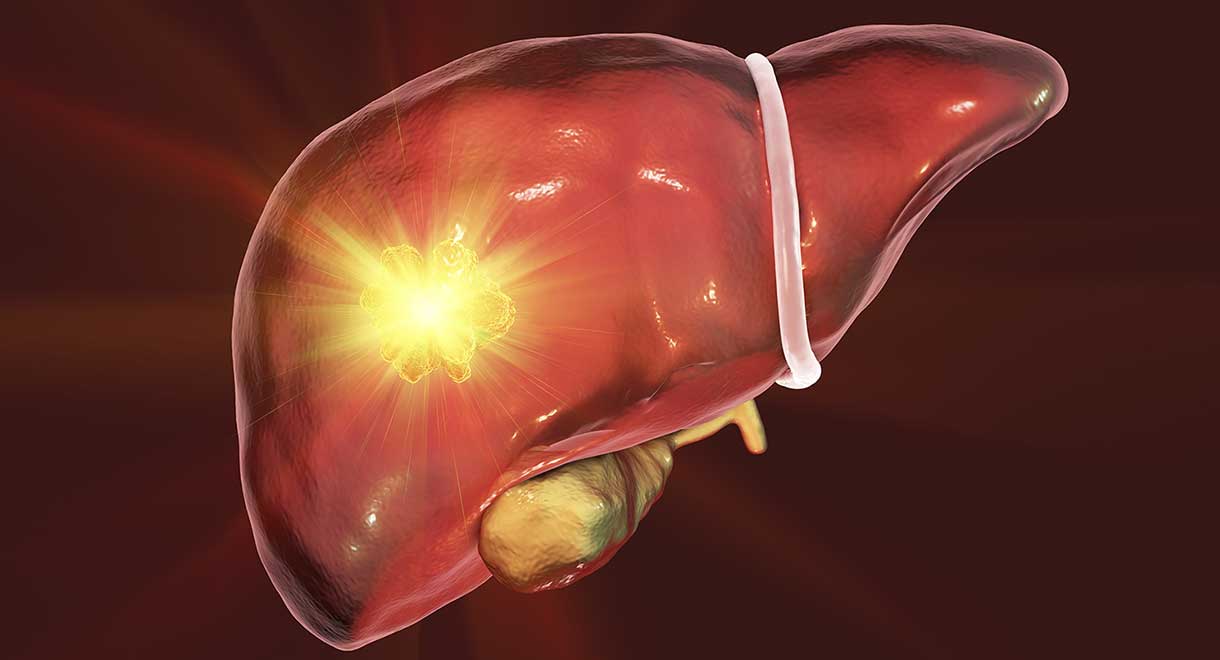 Tumor Hati Adenoma Hepatoselular