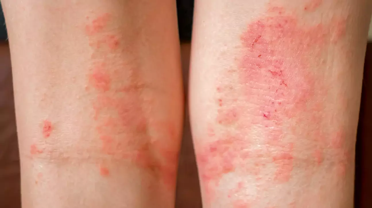 Dermatitis Kronis Pada Tangan dan Kaki