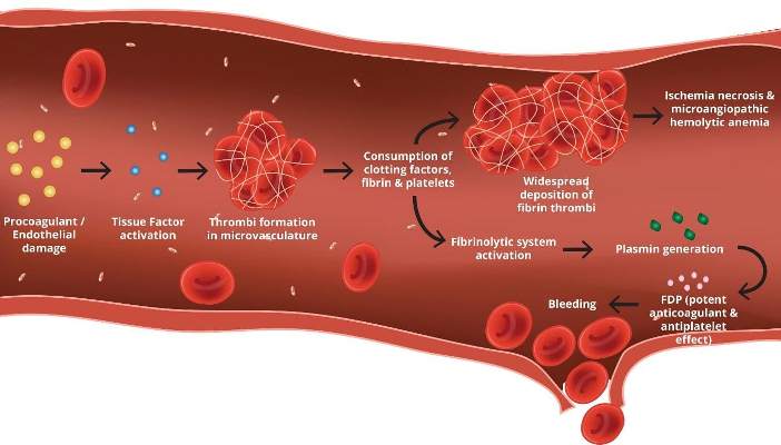 Disseminated Intravascular Coagulation