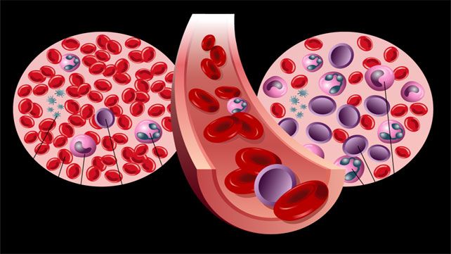 Leukemia Limfositik Akut