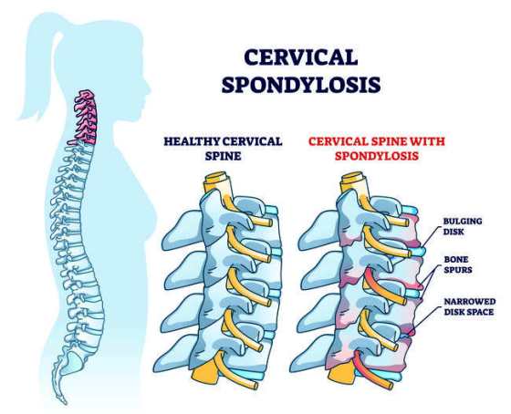 Spondilosis Servikalis