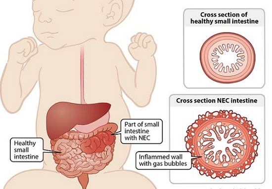 Enterokolitis Nekrotikans