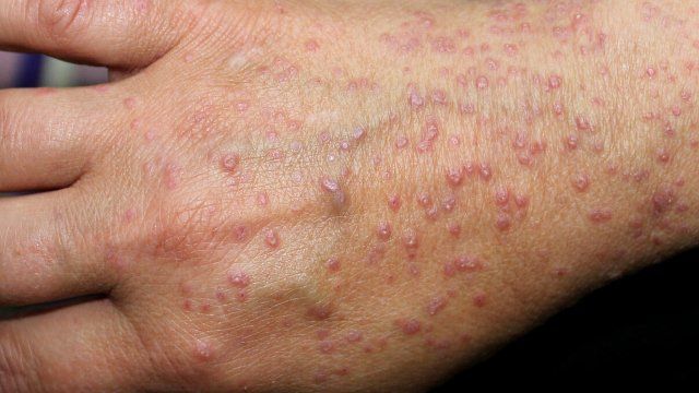 Lichen Planus