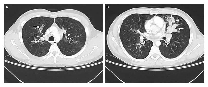 Aspergillosis Bronkopulmoner Alergika