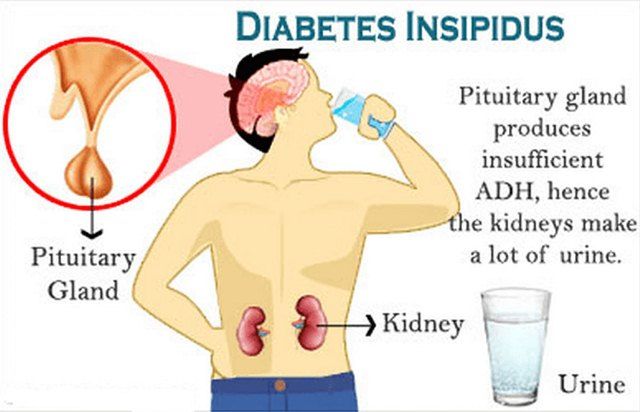 Diabetes Insipidus Nefrogenik