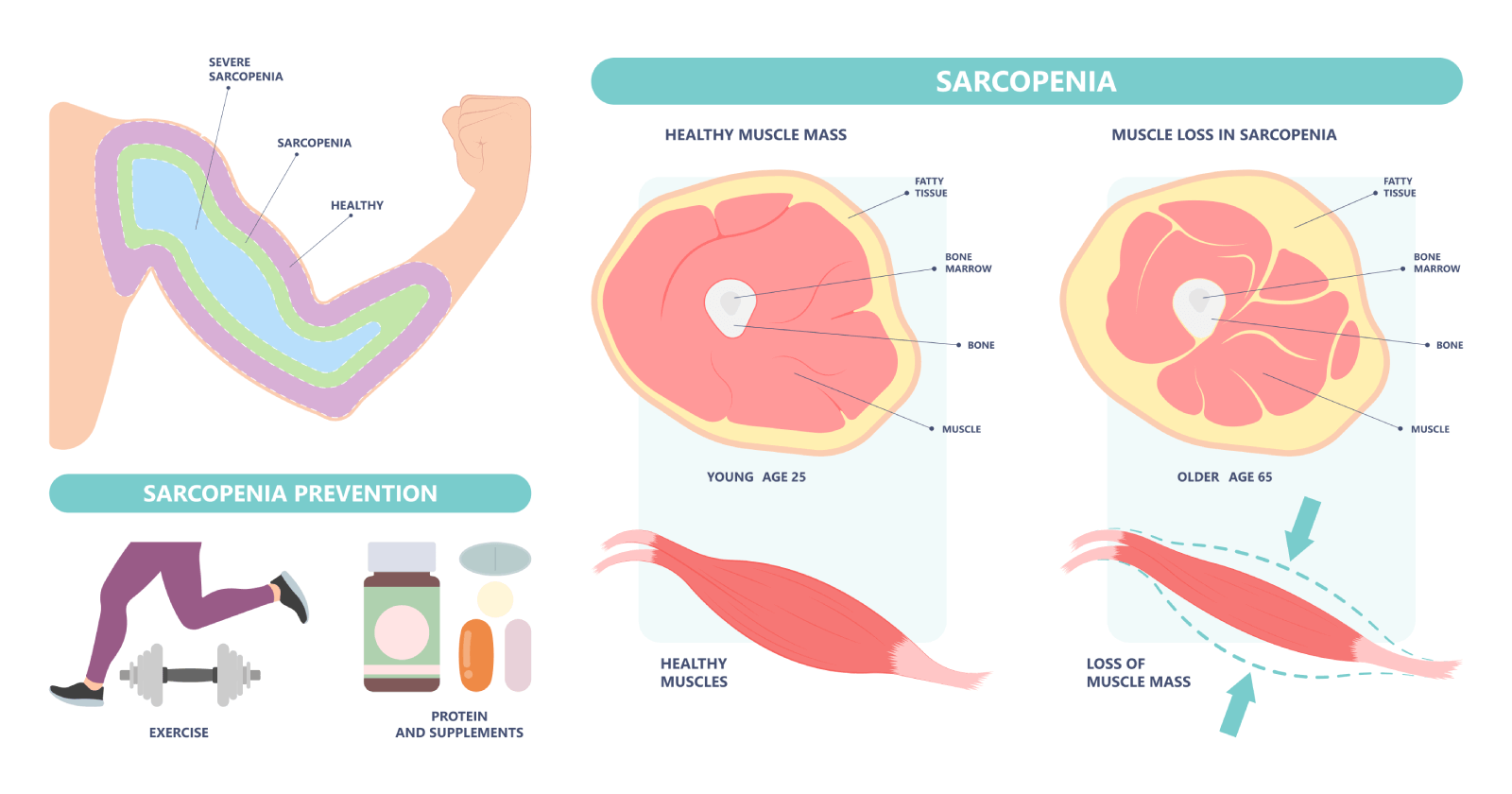 Sarcopenia 