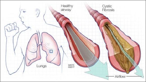 Fibrosis Kistik