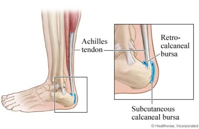 Bursitis Tendon Achilles Posterior