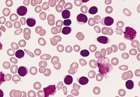 Leukemia Limfositik Kronik