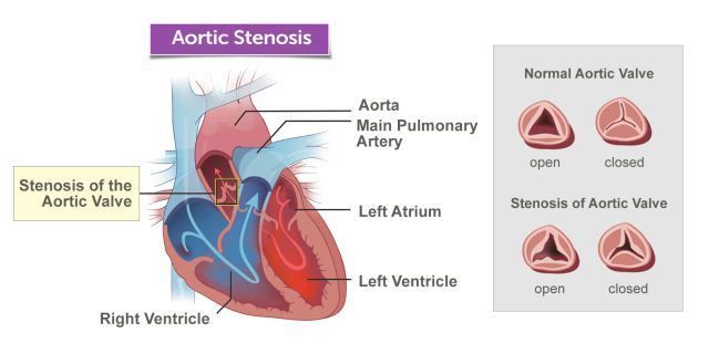 Stenosis Katup Aorta