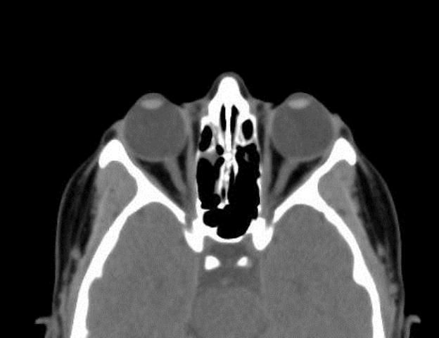 CT Scan Struktur-Struktur di Sekitar Mata (Orbita)