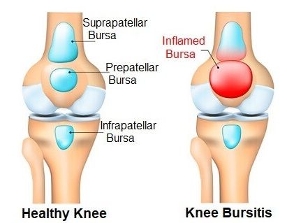 Bursitis