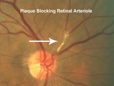 Sumbatan Arteri dan Vena Retina Pusat