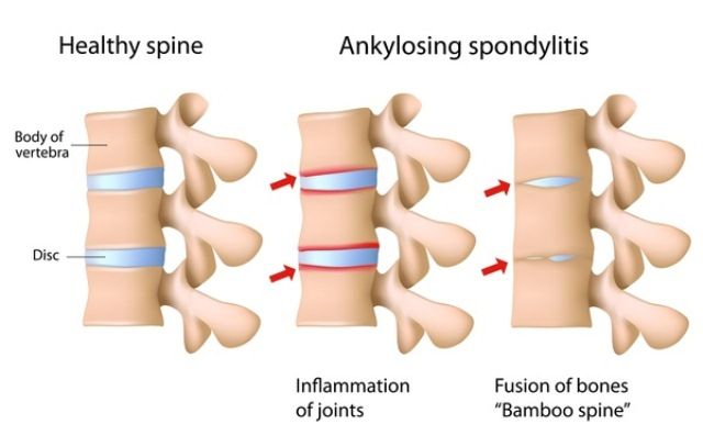 Spondilitis Ankilosa