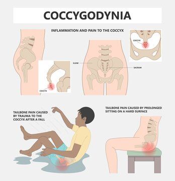 Nyeri Tulang Ekor (Coccydynia)