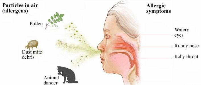 Rhinitis Alergika Musiman