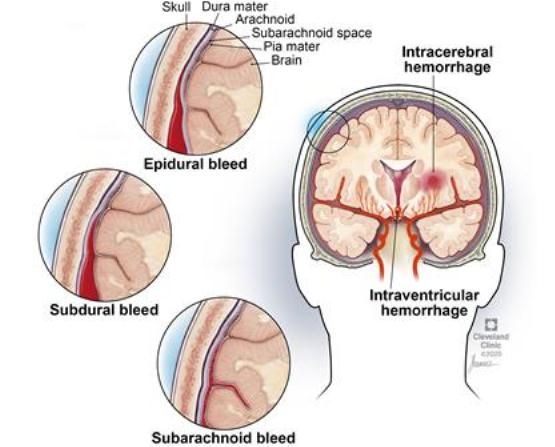 Perdarahan Intrakranial