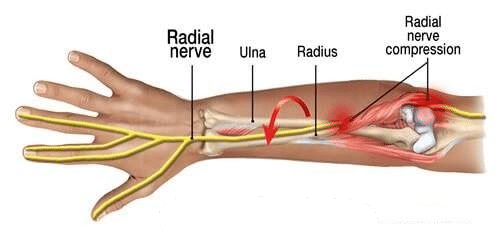 Sindrom Terowongan Radial