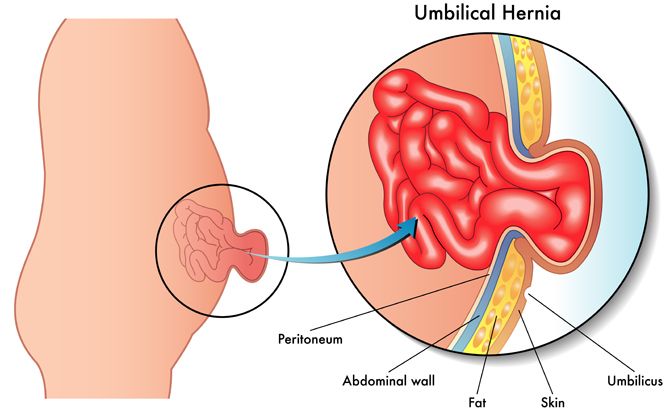 Hernia Umbilikalis