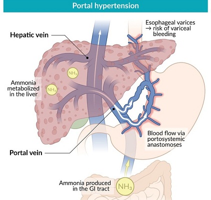 Hipertensi Portal