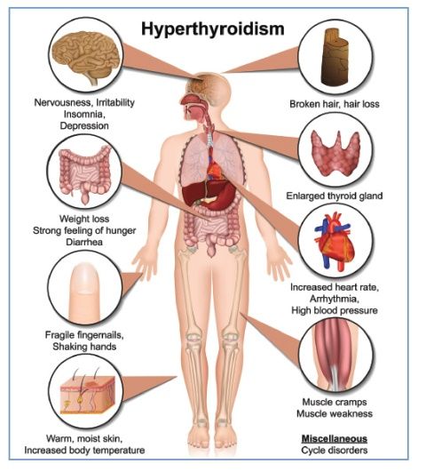 Hipertiroidisme