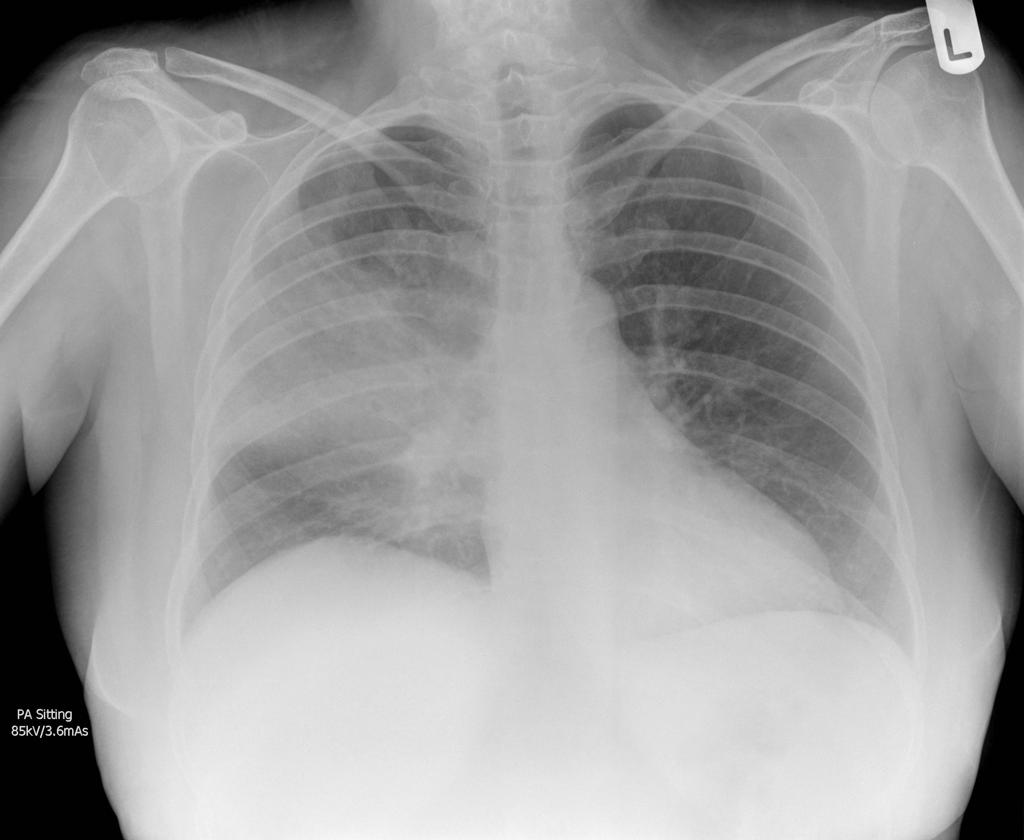 Pneumonia Pneumokokus