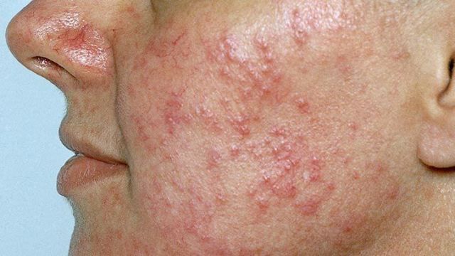 Rosasea (Rosacea)