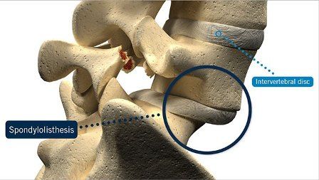 Spondylolisthesis