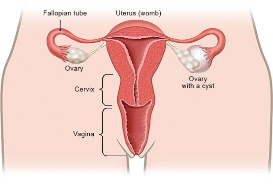 Kista Ovarium (Indung Telur)
