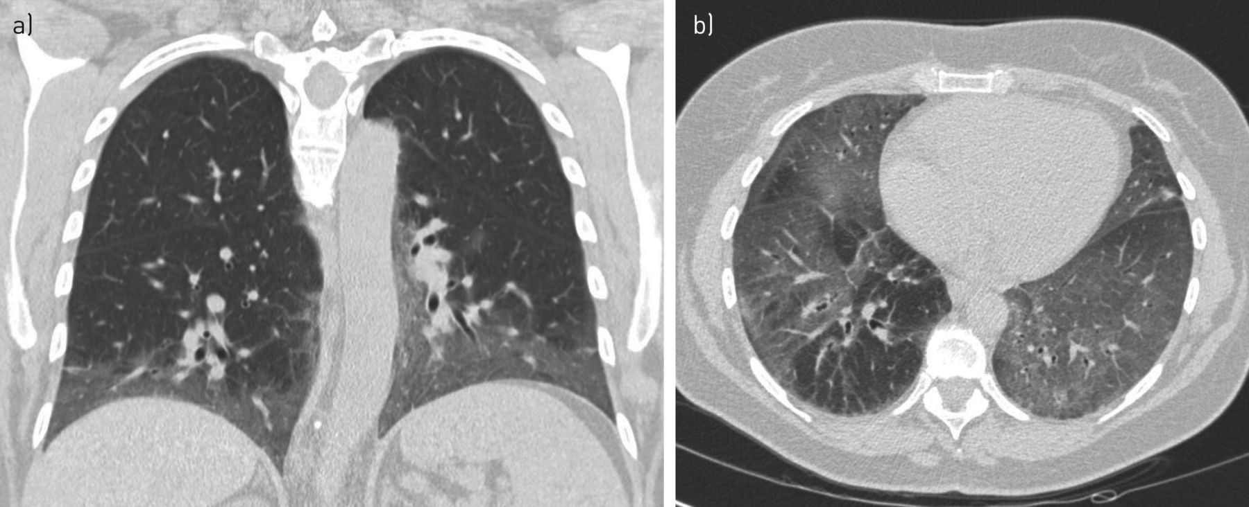 Radang Paru Perokok (Pneumonia Interstitial Desquamatif)