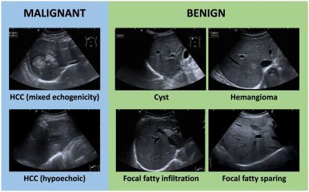 Ultrasonografi Hati