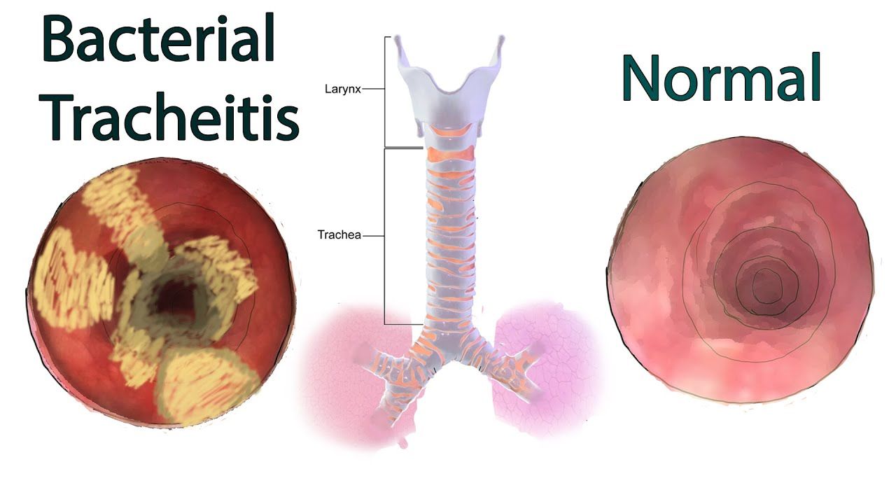 Trakeitis Bakteri (Croup)