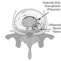 Internal Disc Disruption