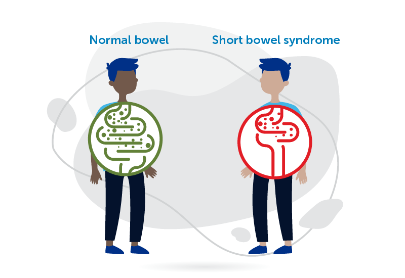 Short Bowel Syndrome