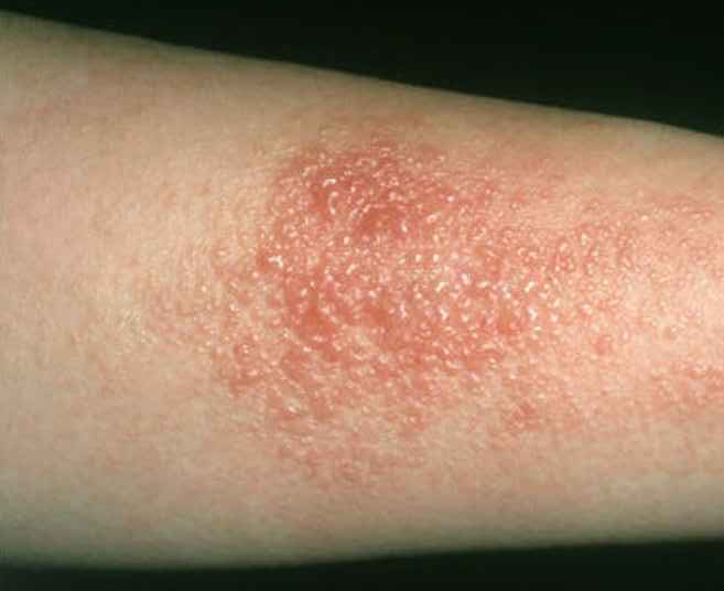 Dermatitis Kontak