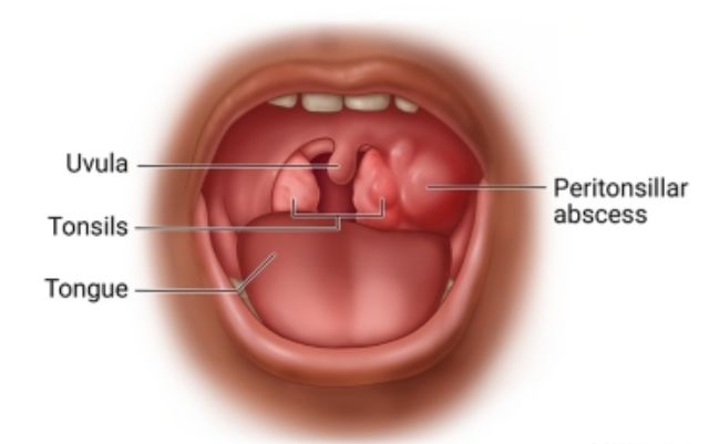 Abses Peritonsillar