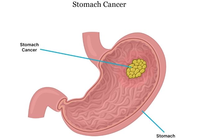 Kanker Lambung