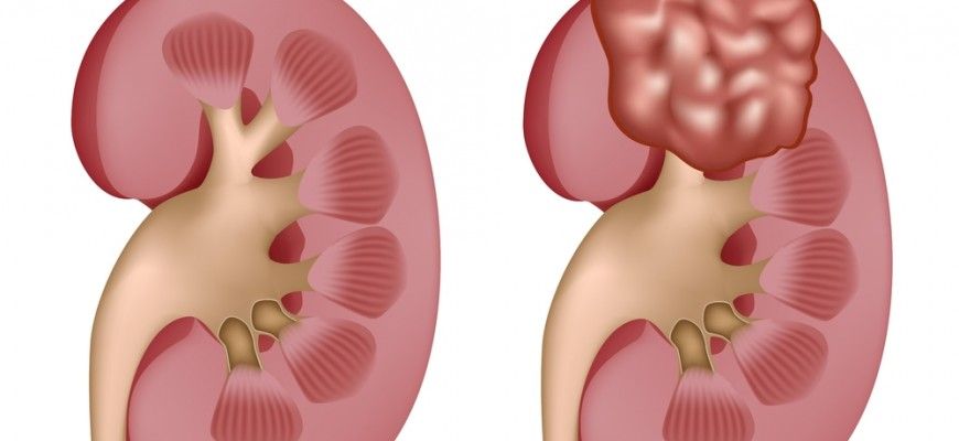 Nephronophthisis dan Penyakit Kista Meduler