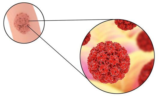 Kutil Genitalis (Kondiloma Akuminata)