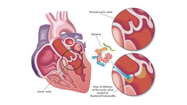 Endokarditis Infektif