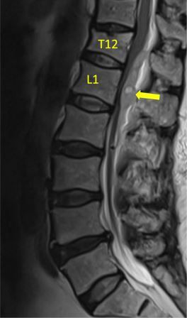 Hematoma Spinalis