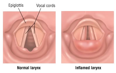 Laringitis (Peradangan Pita Suara)